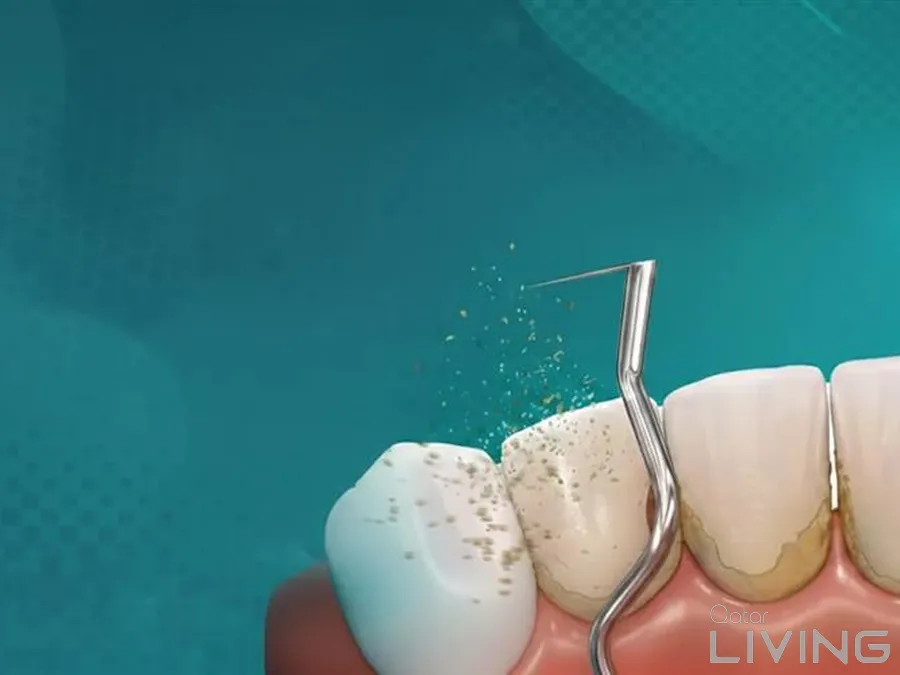 Dental Scaling & Polishing Package